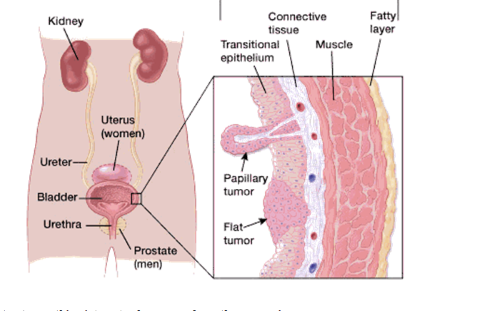 A prostatitis rákról 3 szakaszban)